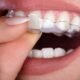Clear Aligner Safety