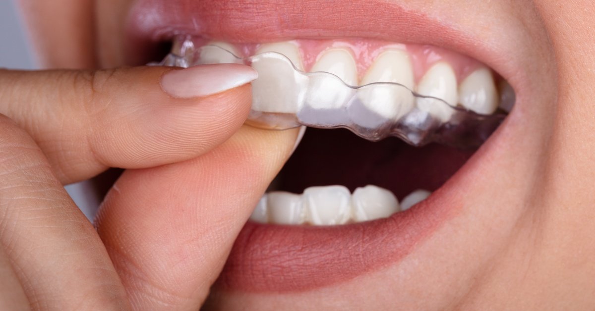 Clear Aligner Safety
